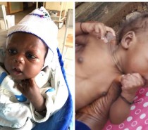 Baby Farouk recovering from malnutrition